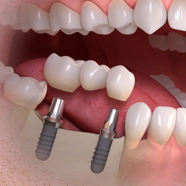 Dental Implants